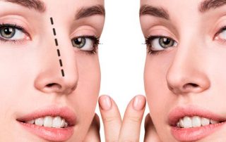 ¿Cómo se realiza una rinoplastia?