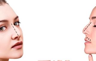 ¿Es necesaria una rinoplastia?