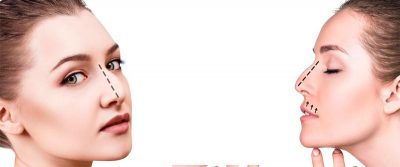 ¿Es necesaria una rinoplastia?
