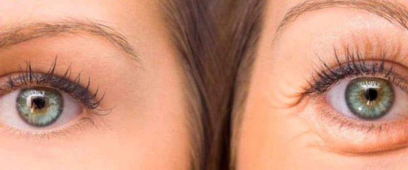 Beneficios de una cirugía de párpados