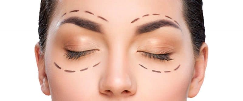 ¿Qué es la blefaroplastia y por qué es importante?