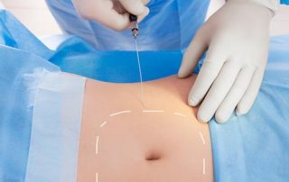 ¿Qué es la Lipólisis láser?
