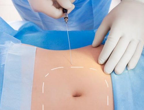 ¿Qué es la Lipólisis láser?