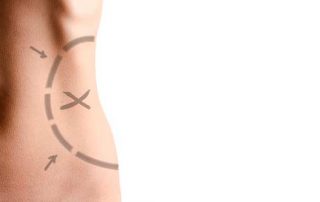 ¿Cómo se hace una lipectomía abdominal?