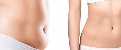 Diferencias entre lipectomía y liposucción