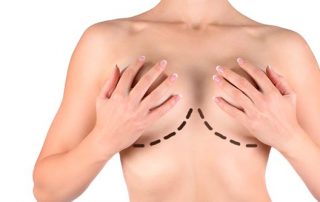 Mamoplastia de aumento