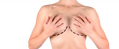 Mamoplastia de aumento
