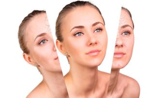 ¿Qué tener en cuenta antes de un rejuvenecimiento facial?