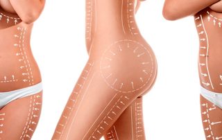 Diferencias entre lipólisis, criolipólisis e hidrolicoplasia