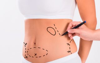 Lipectomía y lipoescultura ¿Son lo mismo?