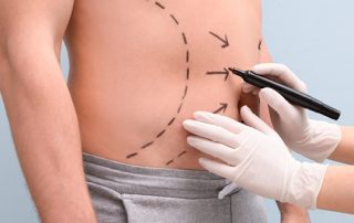 Tipos de lipectomía
