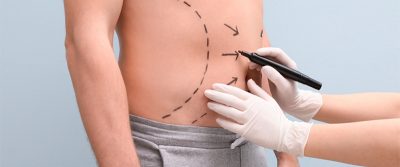 Tipos de lipectomía