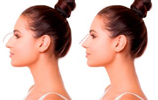 Cirugía estética de la nariz, ¿tratamiento estético o de salud?