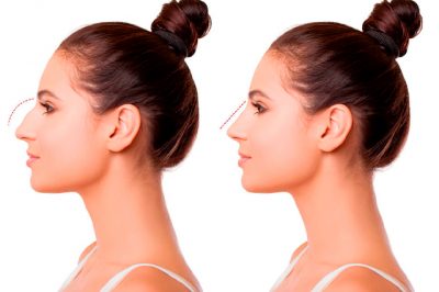 Cirugía estética de la nariz, ¿tratamiento estético o de salud?