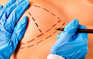 Cuidados en una mamoplastia de aumento