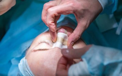 Recomendaciones para una cirugía de nariz