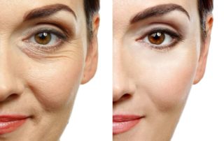 Blefaroplastia