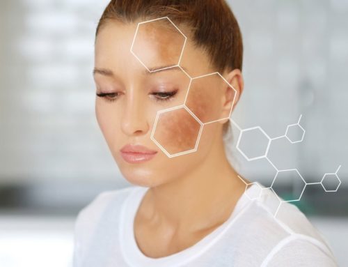 Melasma: Tratamiento para eliminar las manchas en la piel