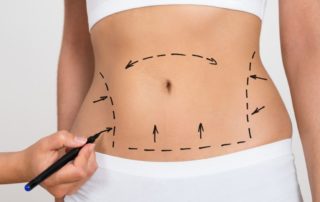 tratamientos para prevenir la fibrosis
